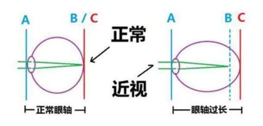 睫狀肌長(zhǎng)期痙攣無(wú)法放松